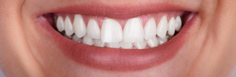 laster tooth whitening in san francisco 1