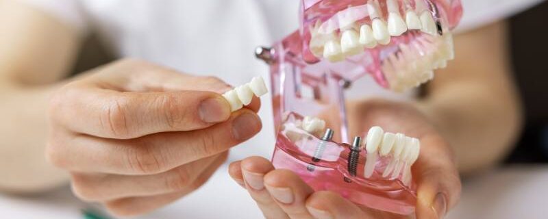san francisco dental implants