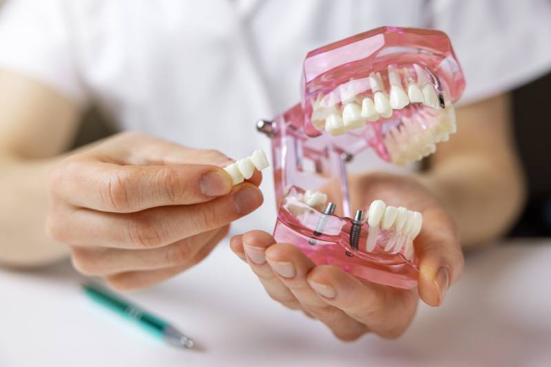 san francisco dental implants