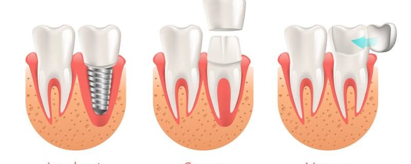 san francisco dental implants dental veneers same day crowns