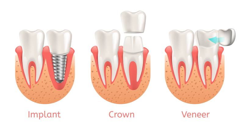 san francisco dental implants dental veneers same day crowns