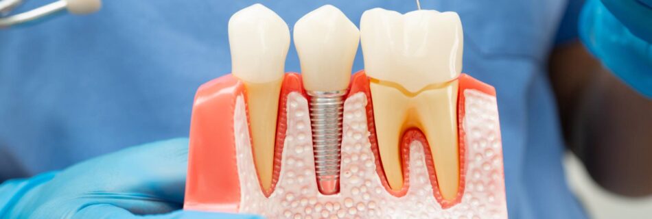 dental implants dentist in san francisco