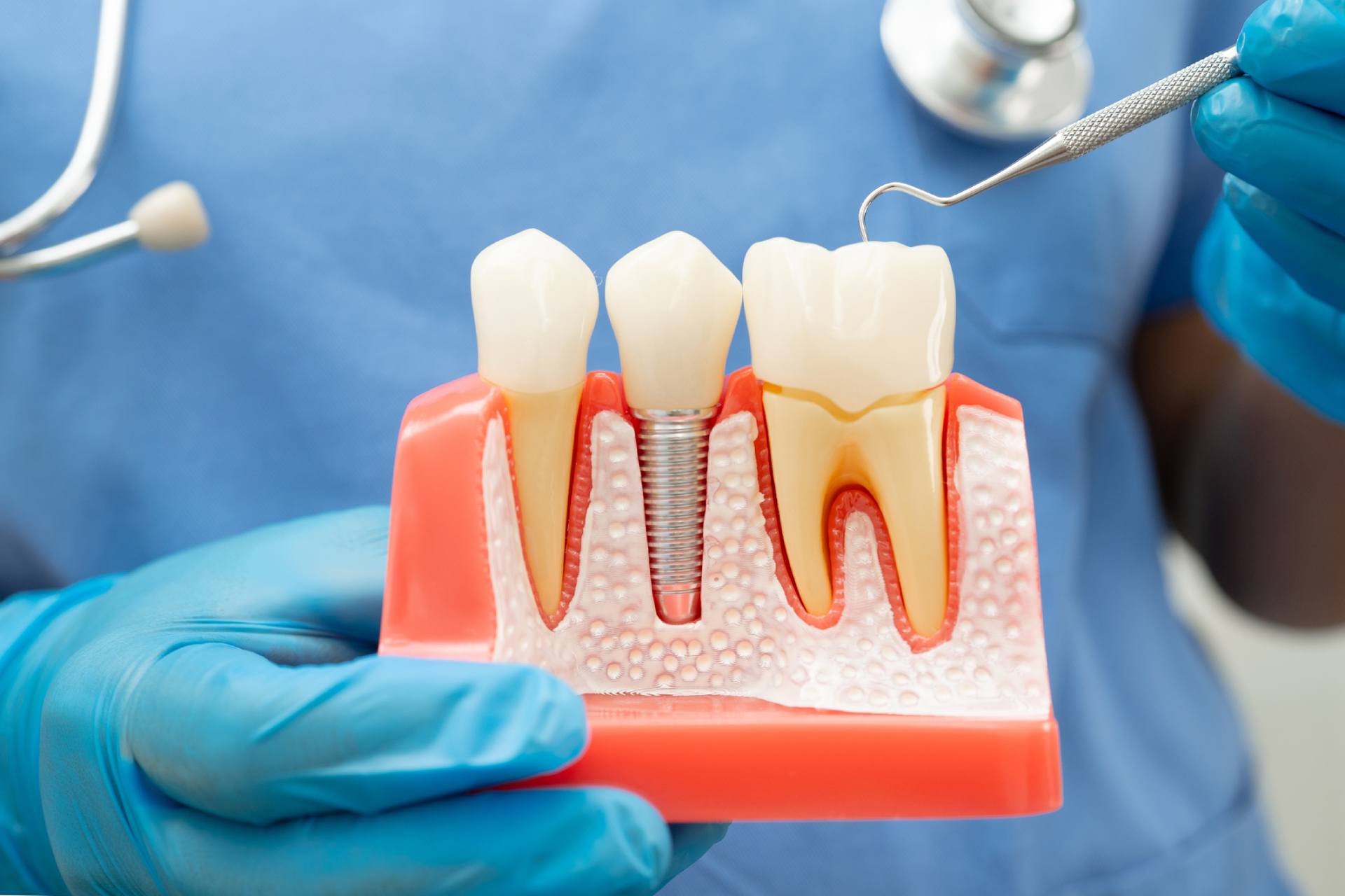 dental implants dentist in san francisco | San Francisco Dental Associates dental implants dentist in san francisco